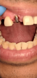 Johnny-Nigoghosian-Dental-Implants-before-4