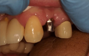 Johnny-Nigoghosian-Dental-Implants-before-5