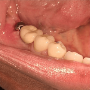 Johnnu-Nigoghosian-Dental-Implants-before-6