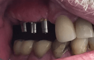 Johnnu-Nigoghosian-Dental-Implants-before-7