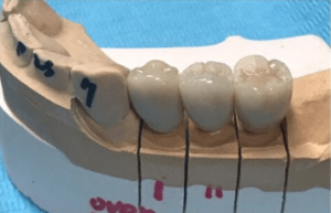 Johnnu-Nigoghosian-Dental-Implants-before-7b