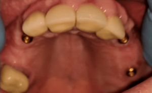 Johnny-Nigoghosian-Dental-Implants-before-8