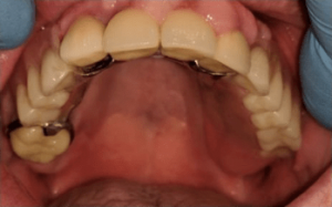Johnny-Nigoghosian-Dental-Implants-before-8b