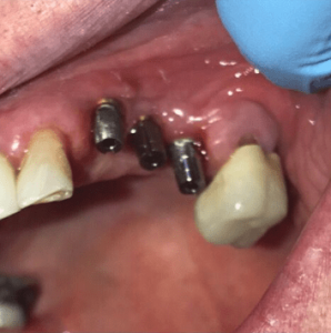 Johnnu-Nigoghosian-Dental-Implants-before-9
