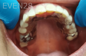 Johnny-Nigoghosian-Implant-Supported-Dentures-after-17