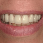 Johnnu-Nigoghosian-Implant-Supported-Dentures-after-5
