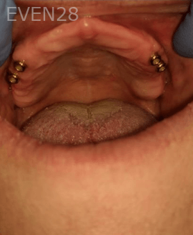 Johnnu-Nigoghosian-Implant-Supported-Dentures-before-12