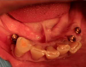 Johnnu-Nigoghosian-Implant-Supported-Dentures-before-15