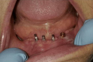 Johnnu-Nigoghosian-Implant-Supported-Dentures-before-16b