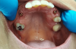 Johnnu-Nigoghosian-Implant-Supported-Dentures-before-17