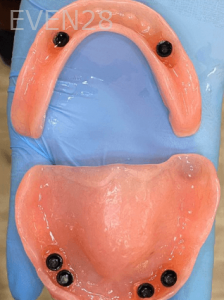 Johnny-Nigoghosian-Implant-Supported-Dentures-before-1b