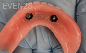 Johnnu-Nigoghosian-Implant-Supported-Dentures-before-3c