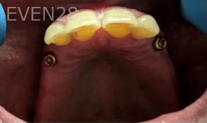 Johnny-Nigoghosian-Implant-Supported-Dentures-before-6