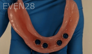 Johnnu-Nigoghosian-Implant-Supported-Dentures-before-7b