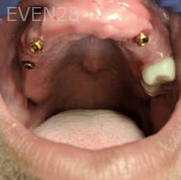 Johnnu-Nigoghosian-Implant-Supported-Dentures-before-8