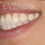 Johnathan-Lee-Invisalign-Clear-Aligners-after-1b