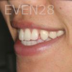 Johnathan-Lee-Invisalign-Clear-Aligners-before-1b