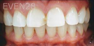 Joseph-Shilkofski-Dental-Bonding-before-1