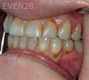 Joseph-Shilkofski-Dental-Bonding-before-2b