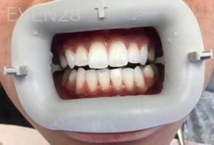 Joseph-Shilkofski-Teeth-Whitening-after-1
