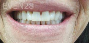 Joseph-Shilkofski-Teeth-Whitening-after-2