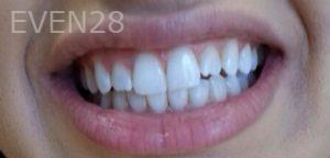 Joseph-Shilkofski-Teeth-Whitening-after-3