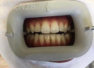 Joseph-Shilkofski-Teeth-Whitening-before-1