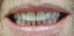 Joseph-Shilkofski-Teeth-Whitening-before-2