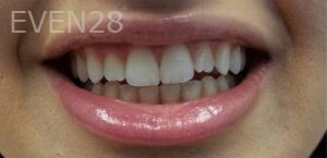 Joseph-Shilkofski-Teeth-Whitening-before-3