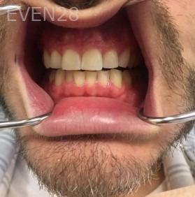 Joseph-Shilkofski-Teeth-Whitening-before-4