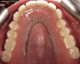 Justin-Braga-Implant-Supported-Dentures-after-1b