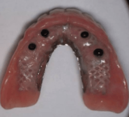 Justin-Braga-Implant-Supported-Dentures-before-1b