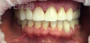 K-Douglas-Baker-Dental-Crowns-after-1