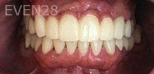 K-Douglas-Baker-Dental-Crowns-after-2