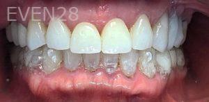 K-Douglas-Baker-Dental-Crowns-after-3