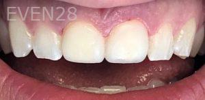 K-Douglas-Baker-Dental-Crowns-after-4