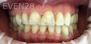 K-Douglas-Baker-Dental-Crowns-before-1