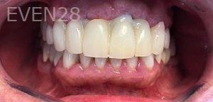 K-Douglas-Baker-Dental-Crowns-before-2
