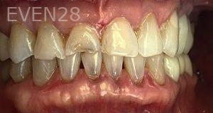 K-Douglas-Baker-Dental-Crowns-before-3