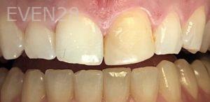 K-Douglas-Baker-Dental-Crowns-before-4