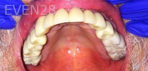 K-Douglas-Baker-Implant-Supported-Dentures-after-1