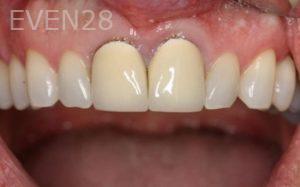 Kalvin Chen Dental Crowns before 1