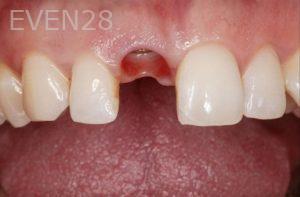 Kalvin Chen Dental Implants before 1