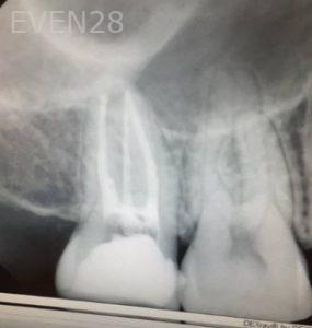 Katherine-Toubian-Root-Canal-after-2