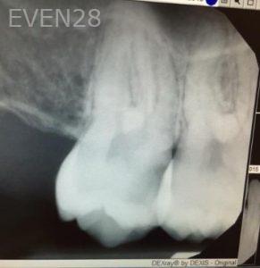 Katherine-Toubian-Root-Canal-before-2