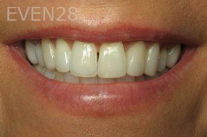 Kristy-Vetter-Dental-Crowns-after-1