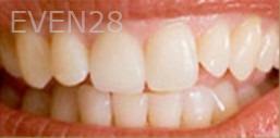 Kristy-Vetter-Dental-Crowns-after-2