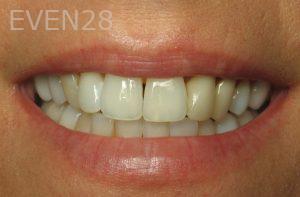 Kristy-Vetter-Dental-Crowns-before-1