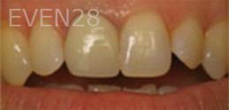 Kristy-Vetter-Dental-Crowns-before-2