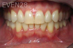 Kristy-Vetter-Invisalign-Clear-Aligners-after-2